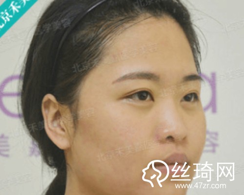 北京禾美嘉醫(yī)療美容自體脂肪填充面部那個(gè)醫(yī)生好？