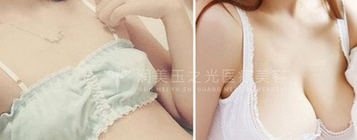 北京潤(rùn)美玉之光自體脂肪豐胸哪個(gè)醫(yī)生好