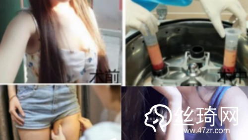 北京潤(rùn)美玉之光自體脂肪豐胸哪個(gè)醫(yī)生好