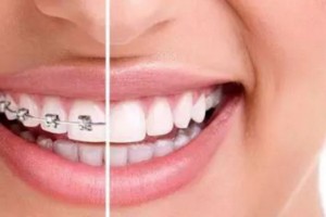 成人做牙齒矯正有危害?牙齒矯正有年齡限制嗎？