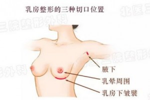 假體隆胸前，我需要做些什么?