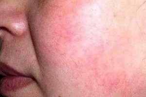 去紅血絲修護(hù)方法有哪些呢？