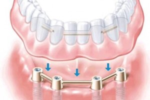 北京京一口腔：種植牙長壽的秘訣及種植牙護(hù)理方法有哪些