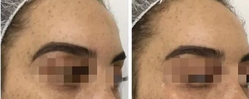 【真人案例賞析】面部年輕化方案:注射肉毒菌素-玻尿酸填充劑