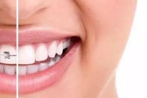 30歲后做牙齒矯正來得及嗎？做正畸會有什么危害？