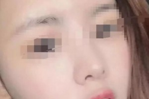 云南瑪麗亞整形美容醫(yī)院做的面部吸脂，原來擁有精致的小臉蛋這么簡單