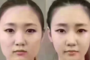 擁有精致小V臉？你只缺一支注射瘦臉注射瘦臉！