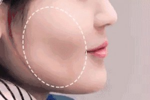 麗都自體脂肪移植，你值得擁有