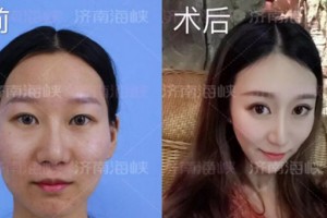 濟南海峽整形自體脂肪填充：取“脂”于你，用“脂”于你!