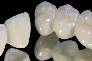 全瓷牙就是烤瓷牙？?jī)烧哂胁顒e嗎？該怎么選擇？