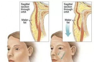 在韓國做去眼袋手術(shù)如何？純真眼底脂肪重排術(shù)價(jià)格曝光