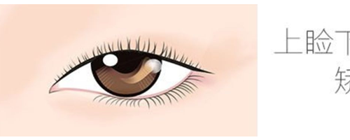 上瞼下垂矯正原理是是什么，上瞼下垂問題應(yīng)該如何矯正？