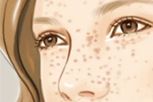 激光祛斑一次有嗎?