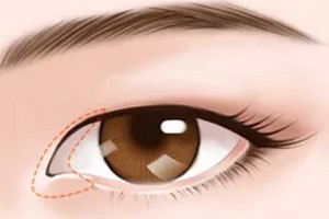 北京開眼角一般花費(fèi)多少錢