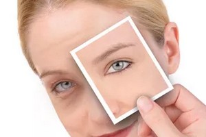 吸脂術(shù)去眼袋優(yōu)缺點有哪些