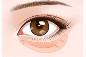 去眼袋手術后遺癥有哪些