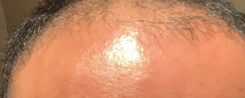 寧波小伙花6萬(wàn)到杭州新生植發(fā)醫(yī)院種頭發(fā)半年了還禿著