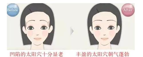 晶馨SG自體脂肪細(xì)胞豐太陽(yáng)穴，秒變V臉女神不是夢(mèng)！