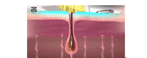 美萊妍學(xué)社做過(guò)激光脫毛的你，對(duì)它真的了解嗎？