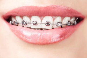 牙齒矯正的注意事項(xiàng)