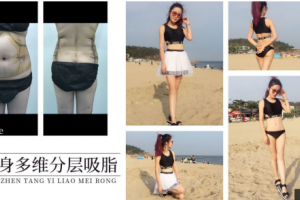 一個疑思，吸脂減肥真的有用嗎？