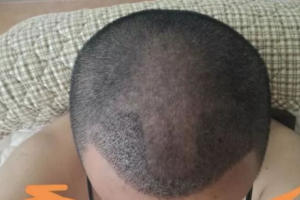 25歲發(fā)際線整體后移 植發(fā)改良我的發(fā)際線 還我青春