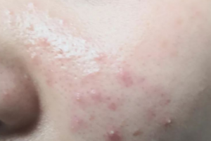 調(diào)節(jié)痘痘為什么不能依靠美容院，化妝品？