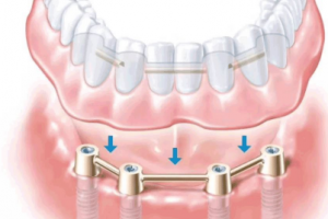 種植牙長壽的秘訣