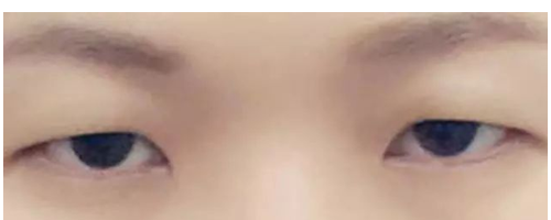 【普賽克】矯正上瞼下垂，get美眼