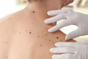 激光激光祛痣，還你肌膚“清白”！