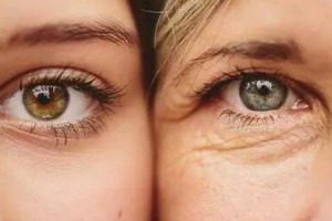 激光去眼袋的優(yōu)點(diǎn)是什么？激光去眼袋有哪些注意事項(xiàng)?