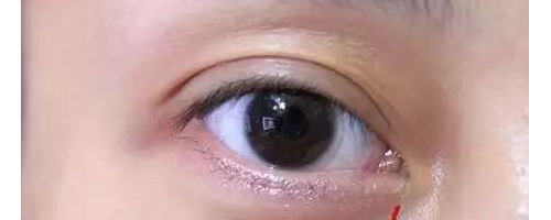 為啥？你做了去眼袋手術后，又復發(fā)了呢？