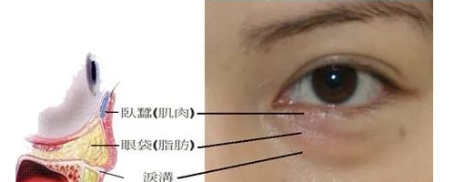 你們可能不知道，淚溝比眼袋丑多了