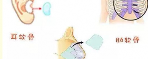 [普及]自體軟骨隆鼻？軟骨來自身體哪個部位呢？