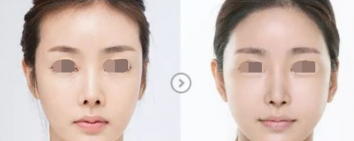 發(fā)際線后退？一招幫你解決！