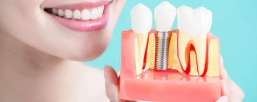 花了上萬塊的種植牙，怎么護理才能更耐用呢？