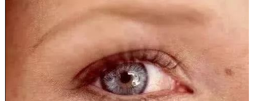 黃褐斑為什么愛反復(fù)？醫(yī)學(xué)博士：祛斑3大金方，排黑素，去褐斑！