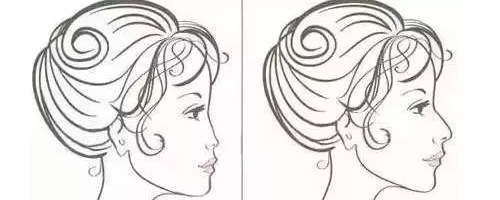 隆鼻N年后會怎么樣？需要再更換嗎？