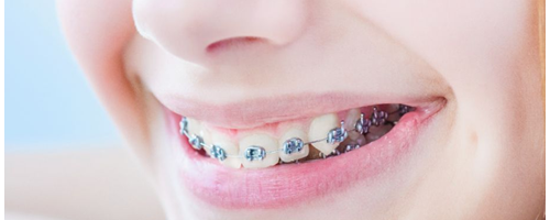 為什么牙齒矯正那么貴？