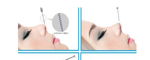 隆鼻要取代假體？感覺(jué)有點(diǎn)兒扯