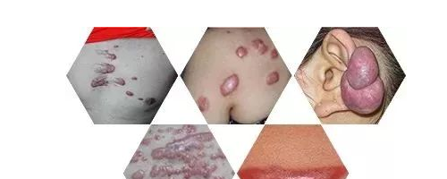 小疙瘩連成疙瘩片，疤痕為什么會(huì)越變?cè)酱螅?>
</a>
<h3 class=