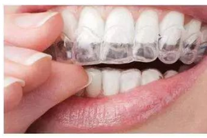 牙齒矯正后，臉會瘦嗎？臉型會產生哪些變化