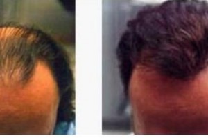 哈爾濱科發(fā)源植發(fā)怎么樣附全新價格表(價目表)