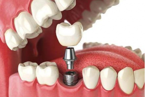 2020沈陽歡樂仁愛口腔醫(yī)院整形價格表(價目表)全新發(fā)布