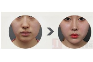 什么是頦部填充術，如何快速消腫