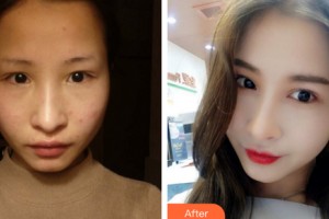 嘉興市曙光中西醫(yī)結合醫(yī)院整形美容科王良發(fā)整形價格表附雙眼皮手術案例展示