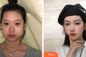 深圳金美人整形外科門診部段國(guó)新整形價(jià)格表附下頜角手術(shù)案例展示