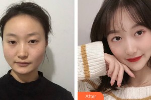 滄州瑞美醫(yī)療美容門診部張鵬整形價(jià)格表附下頜角手術(shù)案例展示