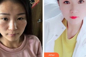 西安光仁醫(yī)院愛斯丁整形中心劉春華整形價(jià)格表附皮膚美容案例展示