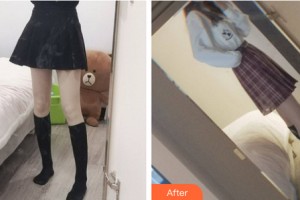 黑龍江解放軍211醫(yī)院整形美容中心龔宇整形價(jià)格表附大腿吸脂案例展示